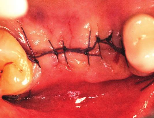 giorni a scalare) per il controllo dell edema post-operatorio e sciacqui con clorexidina 0.2% dal giorno successivo (1 sciacquo al giorno per 15 gg).