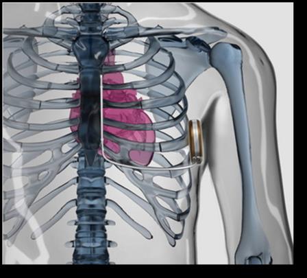 Il Sistema S-ICD L approccio sottocutaneo Nessun catetere all interno del cuore Sistema venoso preservato Impianto
