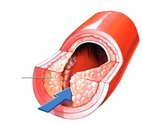 5 L ATEROSCLEROSI Con il termine aterosclerosi si definisce il deposito di grasso (placca) nelle arterie che progressivamente ostruisce il