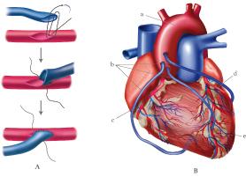 coronarie può essere necessaria una procedura chirurgica in cui