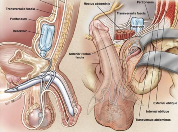 Posizionamento del Reservoir Posizionamento ectopico del Reservoir con monoincisione Sede retromuscolare sovrafasciale Non richiede seconda incisione Molto agevole dall approccio