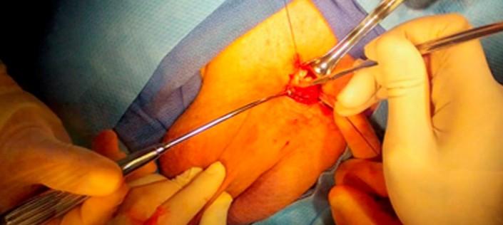 Approccio Chirurgico Approccio Chirurgico: 1) Peno-scrotale