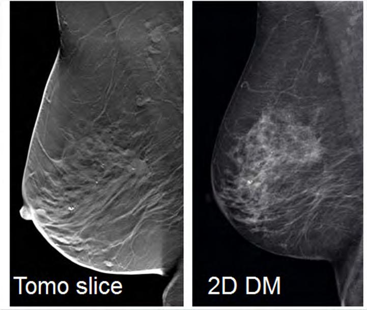 3D Breast