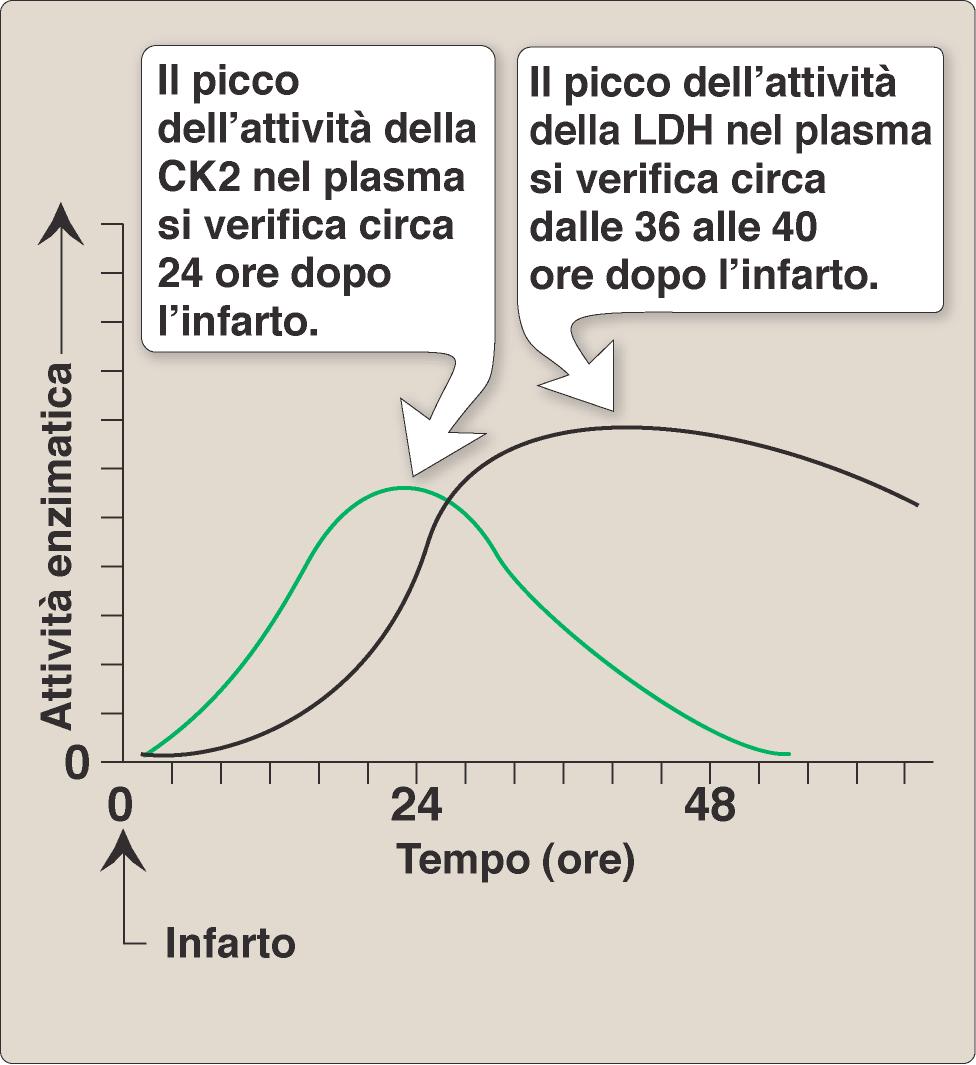 Infarto