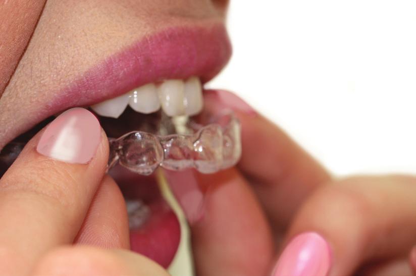 COME FUNZIONANO? Gli allineatori Smilers sono realizzati su misura e si adattano perfettamente ai denti del paziente.