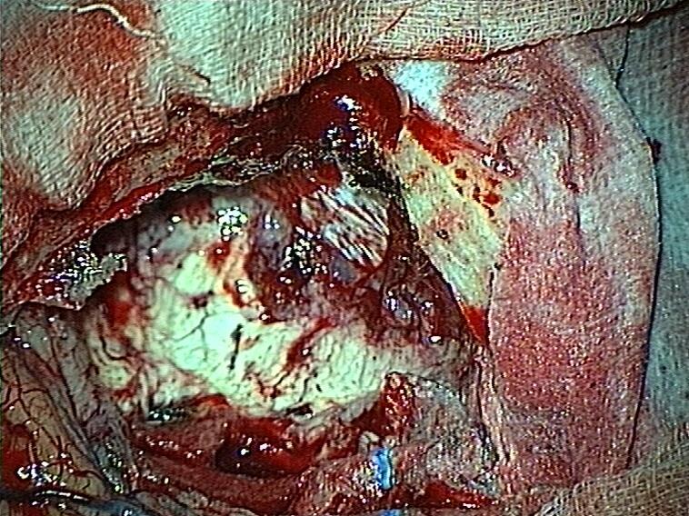 La completa asportazione del tumore consente di evidenziare il letto della neoplasia (freccia azzurra), la falce dell encefalo