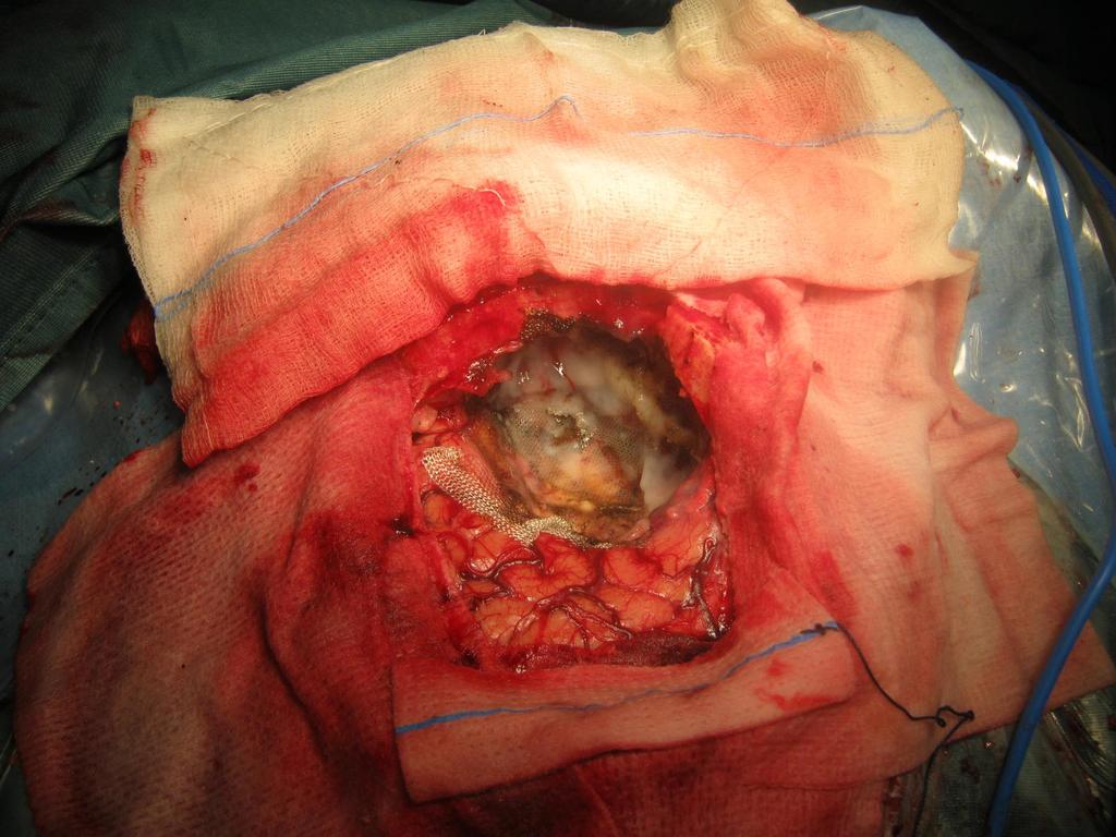 Il letto tumorale viene rivestito con surgicel e colla