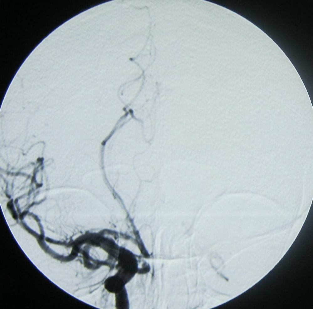 Il processo espansivo appare vascolarizzato dal ramo anteriore dell arteria meningea media di sinistra e dai rami