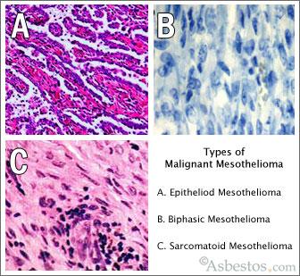 1. Background Il mesotelioma pleurico maligno (MPM) è una neoplasia rara che origina dalla pleura e riconosce nell amianto il principale fattore eziopatogenetico.
