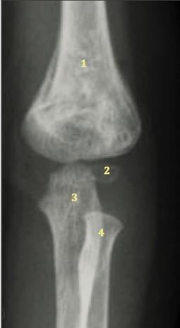 5 1- Omero 2- Nucleo ossificazione per il