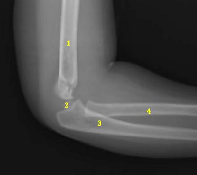 pediatrico 1- Omero 2- Nucleo ossificazione per