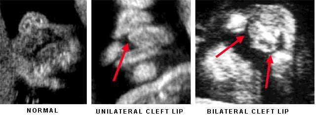 Labiopalatoschisi Maxillo-facciale Diagnosi Piano