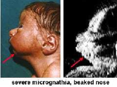 Micrognazia Maxillo-facciale Prevalenza 1:1000 nati Profilo anomalo Mento retratto Labbro superiore prominente Mandibola piccola Possibile polidramnios