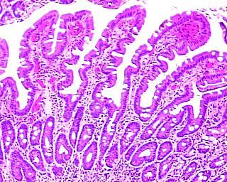 Dal Rotavirus alla celiachia?