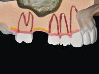 TECNICA CHIRURGICA c d Figur 3.8 () Modello dimostrtivo con simulzione del seno mscellre e crest residu di ltezz 8 mm; () modello prim dell perforzione; (c) fres trdizionle 2,0 mm con stop L.