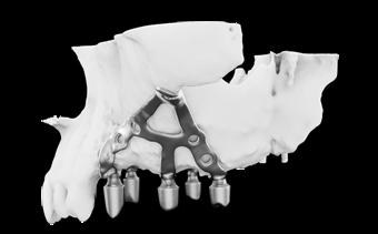 impianto iuxta osseo è disegnata a partire dall esame del paziente, personalizzata in base alle caratteristiche anatomiche e alle esigenze protesiche ed è prodotta in titanio biocompatibile e