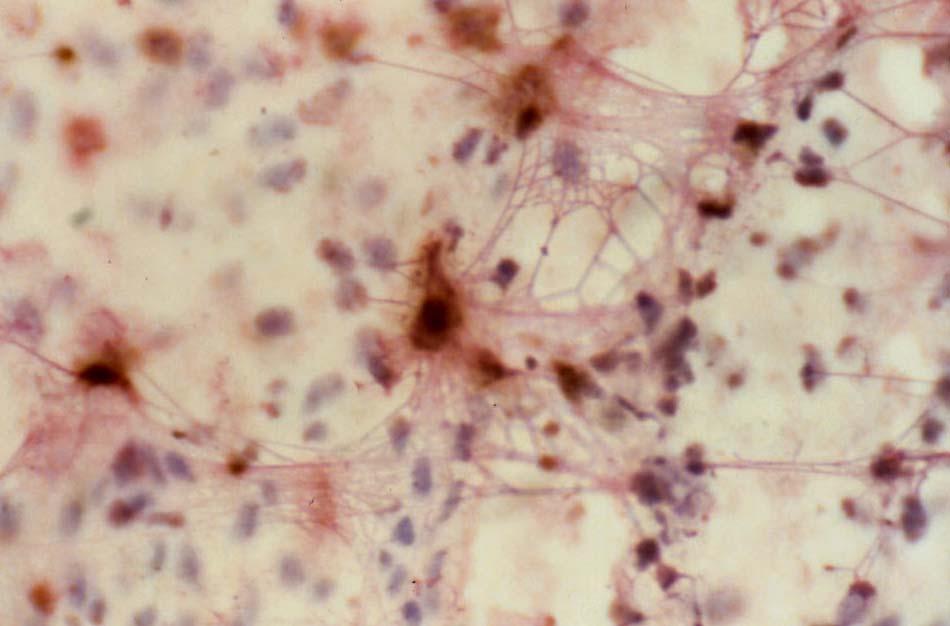 Estrogen receptors on synovial macrophages (double staining - Cutolo et al 2003) Estrogen receptors Synovial tissue