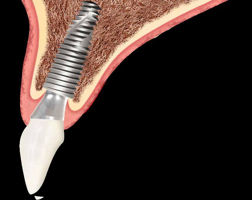 LA FILOSOFIA DI NEODENT IMPLANTOLOGIA DENTALE ALL AVANGUARDIA. Leader nei trattamenti a carico immediato.