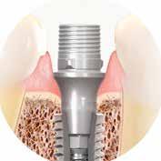 cementati, a livello implantare o di moncone, da tradizionale a digitale.