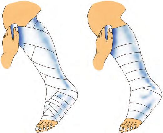 Terapia anticoagulante Diagnosticata la trombosi, la terapia anticoagulante si effettua generalmente mediante iniezioni (di eparina o eparina a basso peso molecolare).