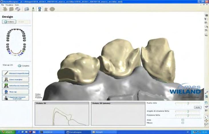 DATI CLINICI SPESSORE DEL FRAMEWORK: 0.3 mm (Lava 3M ESPE) 0.4 mm (Procera Nobel Biocare) per elementi singoli anteriori 0.