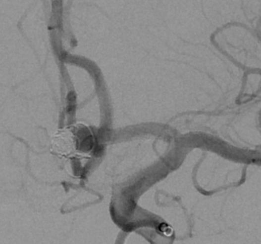 embolizzazione e