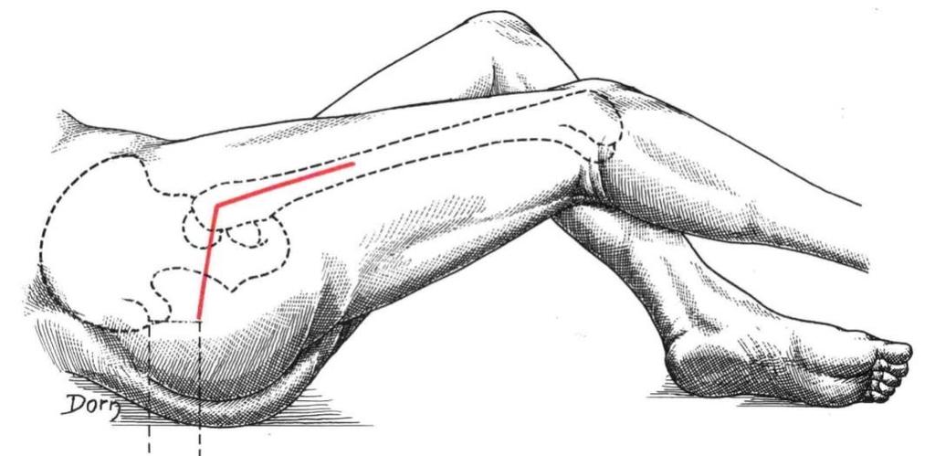 TECNICA CHIRURGICA Attraverso un incisione di circa 8 cm a livello del gran trocantere femorale (natica) si separano i tessuti e si giunge ad esporre l articolazione.