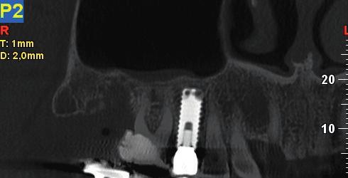 implantare e visualizzare la posizione del canale mandibolare.