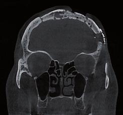 scattering risulta quasi inesistente e le strutture anatomiche