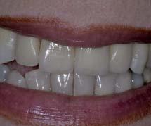 Il piano di trattamento per il restauro del dente singolo: dente anteriore: - approccio conservativo - approccio protesico