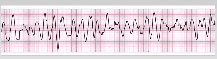 BLS-D Valuta il ritmo In presenza di FV/TV caricare il defibrillatore (360 J monofasico, 150-360 J bifasico) mentre un secondo soccorritore continua le compressioni toraciche Non appena il