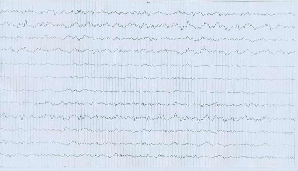 3 EEG dopo circa 72 ore dall inizio della cefalea EON : nella norma. Paziente calma, collaborante, non ha cefalea, amnesia prevalentemente anterograda.