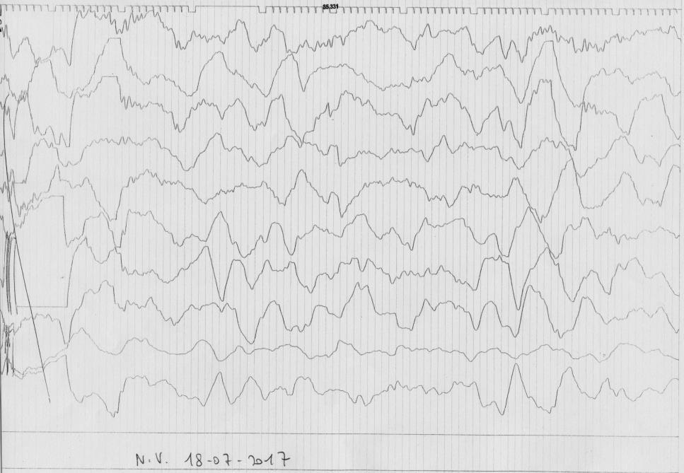 1 EEG eseguito a distanza di circa 3,5-4