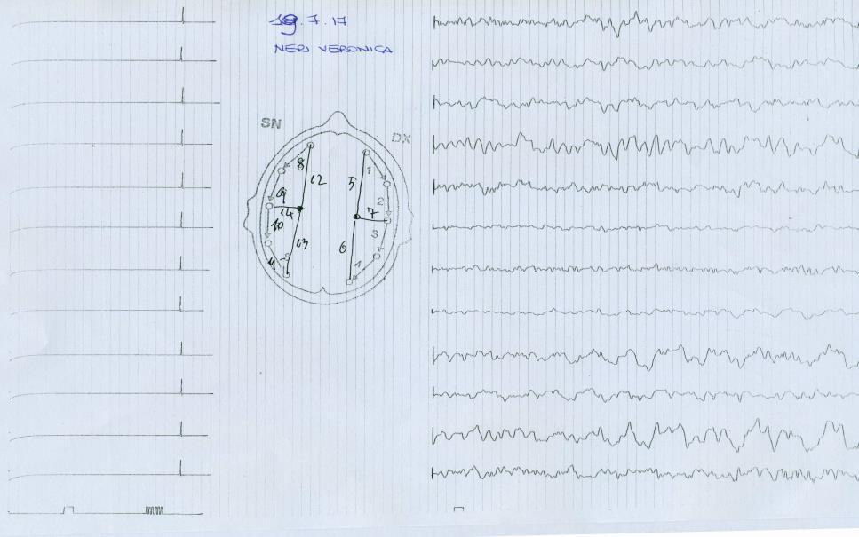 Stato confusionale 2 EEG eseguito a