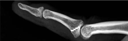 L articolazione PIP, spesso subisce lesioni a causa della propria posizione vulnerabile nella mano.
