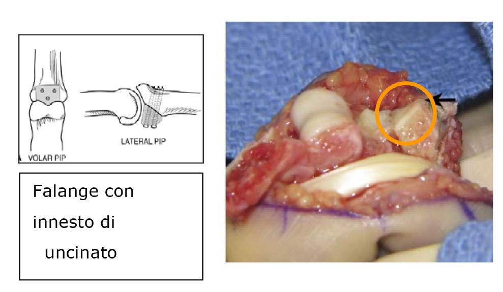 PIPJ Fracture/ Dislocation Fig.2.