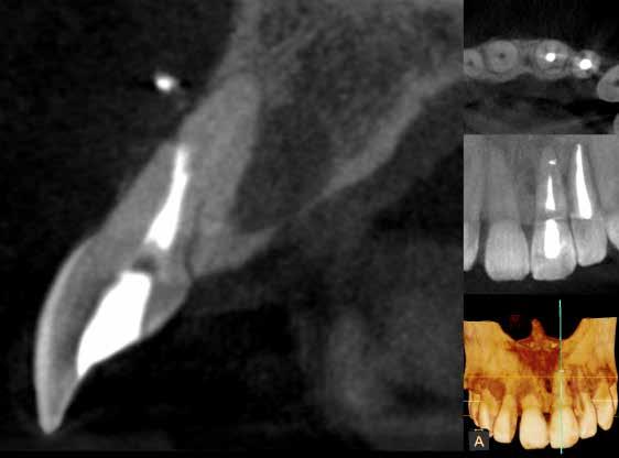 p 20 e per le esigenze endodontiche Programma 3D dedicato per endodonzia Esteso alla sola regione d'interesse (5 cm x 5 cm) Risoluzione