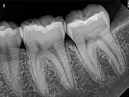 endodonzia (5 cm x