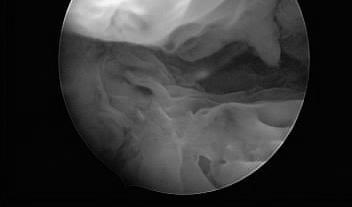 UTERO La cavità uterina comunica in alto, tramite il lume tubarico, con la cavità endoperitoneale ed in basso, tramite il canale cervicale, con la vagina e quindi con l esterno.