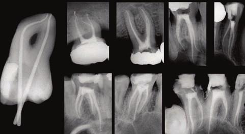 generazione: PathFile, ProGlider e ProTaper Next.