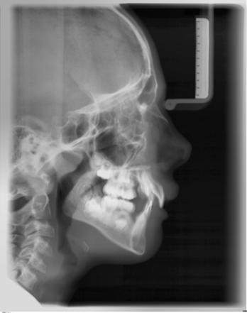5 Uso 5.9 Teleradiografia 5.9.1.3 C3 Radiografia laterale In questa tecnica radiografica, sulla radiografia viene visualizzata una scala metallica integrata nel poggianaso.