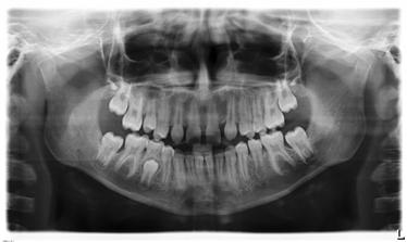 1 P1 Radiografia panoramica La ripresa visualizza la completa zona dentale con rami ascendenti.