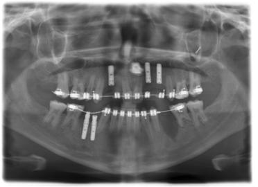 5 Uso 5.4 Radiografia panoramica e radiografia bite-wing 5.4.1.2 P2 Radiografia panoramica, senza rami ascendenti La ripresa visualizza una zona dentale ridotta senza rami ascendenti.