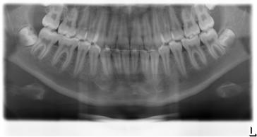 5 Uso 5.4.1.3 P10 Radiografia panoramica per bambini La ripresa visualizza una zona dentale ridotta senza rami ascendenti. La dose di radiazione viene ridotta sensibilmente con questa ripresa.