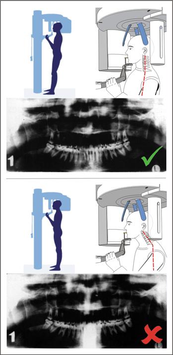 5 Uso 5.4 Radiografia panoramica e radiografia bite-wing 5. Verificare la posizione della colonna vertebrale.