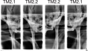 5 Uso 5.5 Radiografia dell'articolazione temporomandibolare 5.5.1.2 TM2.1 / TM2.