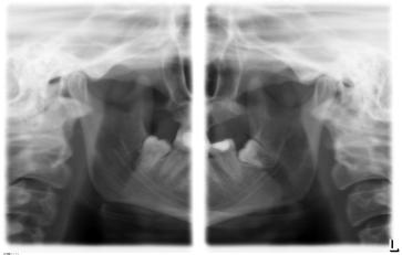 temporomandibolari in direzione di irradiazione posteriore anteriore con bocca aperta e chiusa in rappresentazione quadrupla su un'immagine.