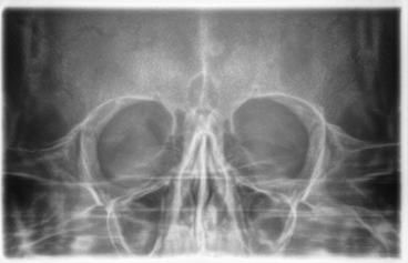 5 Uso 5.6 Radiografia dei seni paranasali 5.6.1 