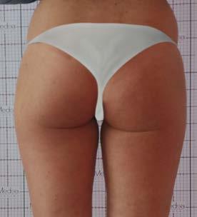 smagliature e della cellulite buccia d arancia.