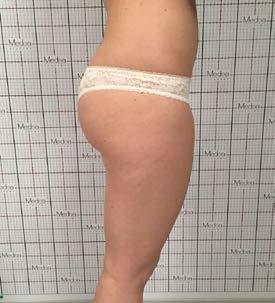 TRATTAMENTO ARTI INFERIORI CELLULITE - TONIFICANTE Nome: F. B.